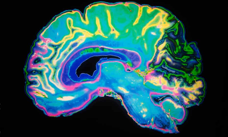 Artificially coloured MRI scan of human brain