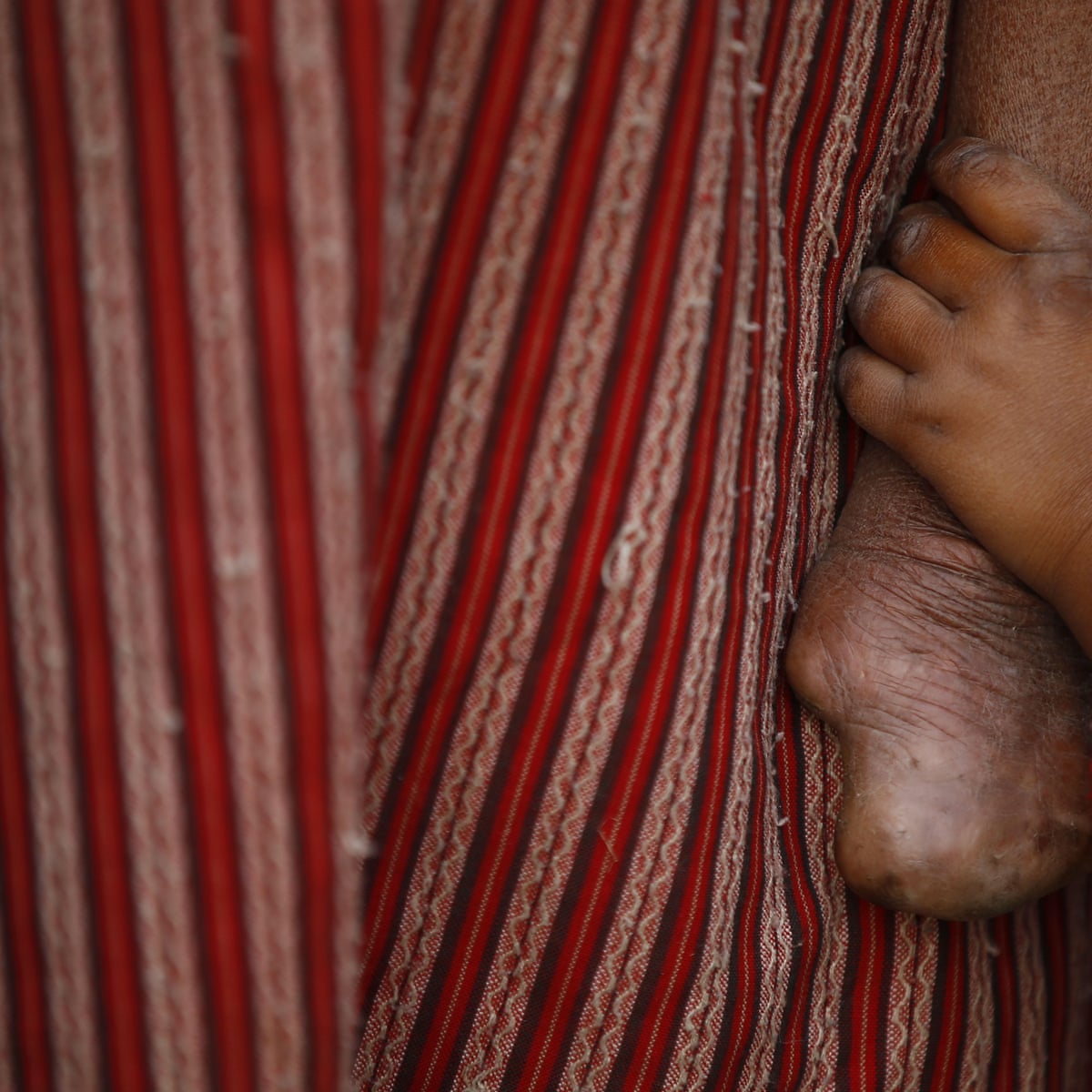 Shadow Of Leprosy Falls Again As Experts Claim Millions Of Cases Go Undiagnosed Global Health The Guardian