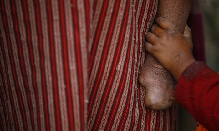 Shadow Of Leprosy Falls Again As Experts Claim Millions Of Cases Go Undiagnosed Global Health The Guardian