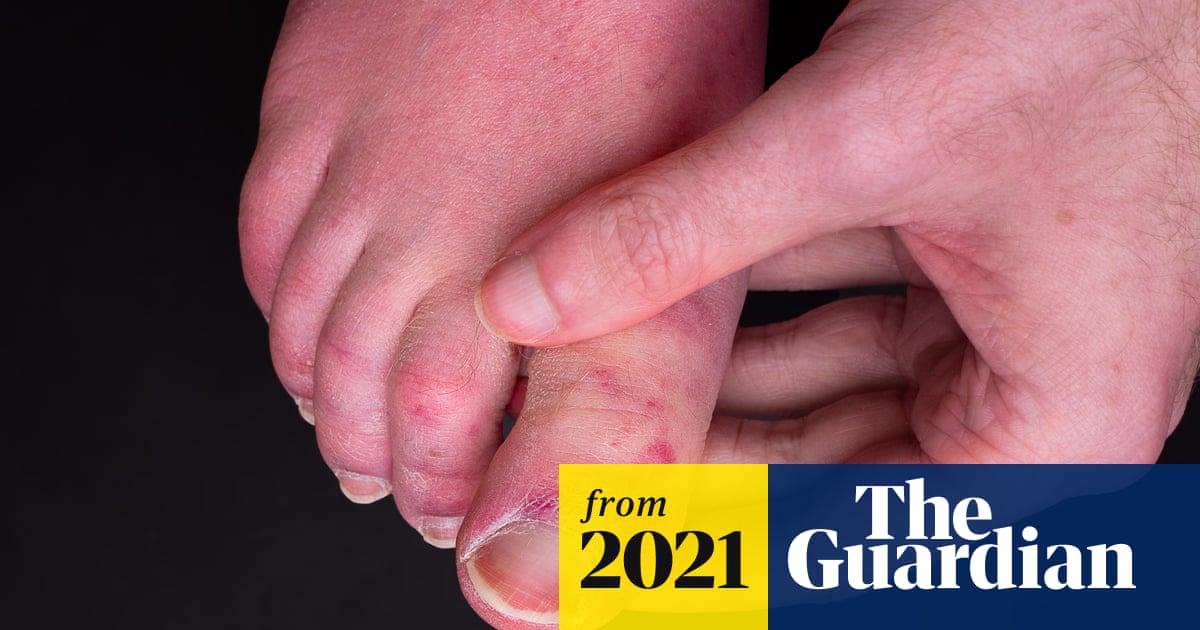 ‘Covid toe’ may be side-effect...