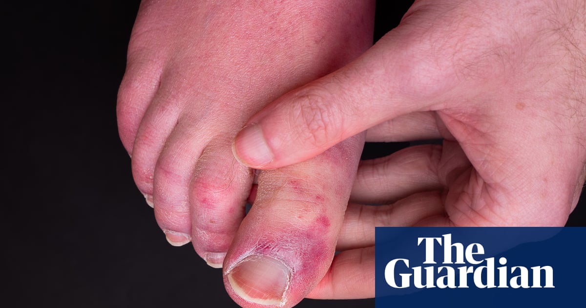 ‘Covid toe’ may be side-effect of immune response, says study