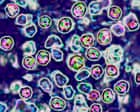 Two unvaccinated people die of measles in Pennsylvania