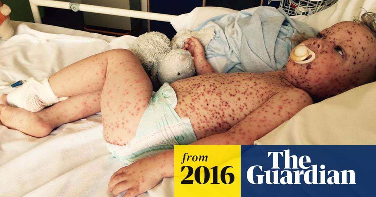 'Worst case of chickenpox' sparks call for rethink on vaccination