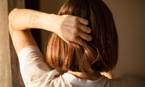 Rear view of a woman with bob haircut, holding her head.Person suffering from headache. Migraine. Light sensitivity.