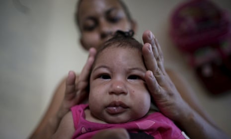 Rosana Vieira Alves fixes the hair of her daughter, Luana Vieira, who was born with microcephaly