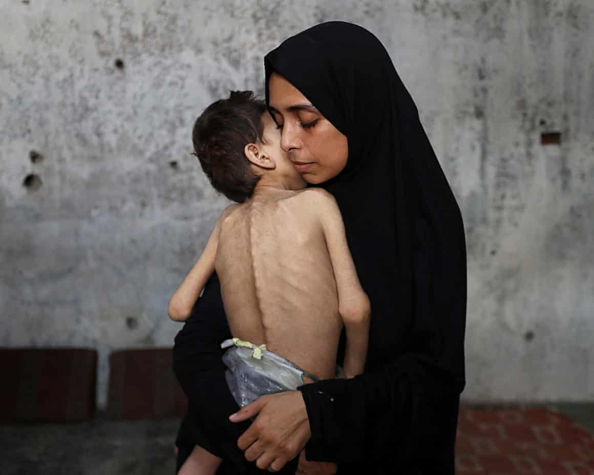Samah Matar, a displaced Palestinian mother, holding her malnourished son Youssef, who has cerebral palsy, in Gaza City on 24 July.