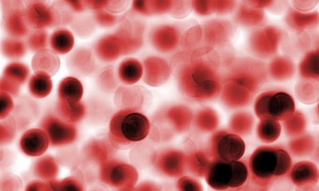 Blood cells viewed under a microscope. AML is a blood cancer that most commonly affects those over the age of 65. 