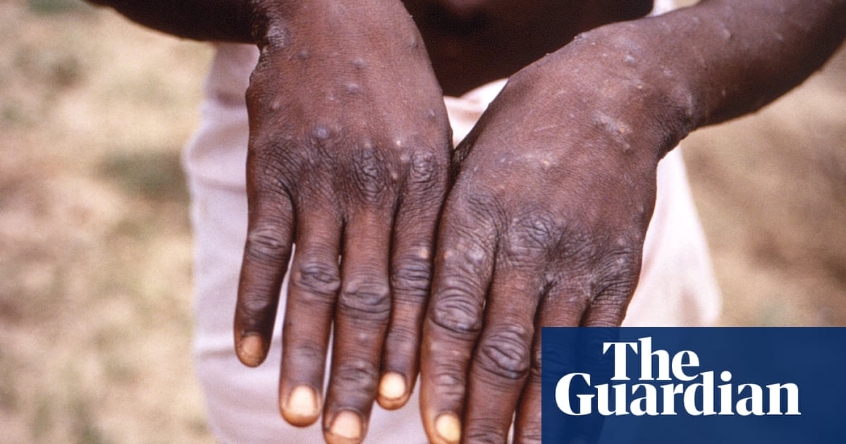 Monkeypox outbreak was waiting to happen, say scientists