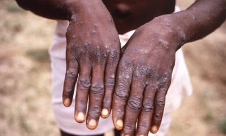An image, issued by the CDC, taken during an investigation into an outbreak of monkeypox, which took place in the Democratic Republic of the Congo, 1996 to 1997.