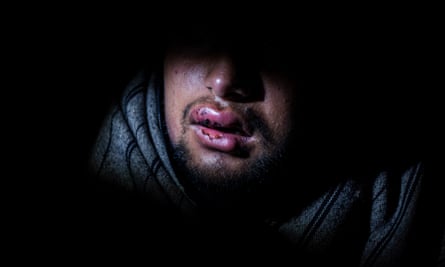 Hammad, 17, from Pakistan, with his lips wounded and swollen