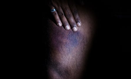 Bruising on the thigh of Anees, 43, from Pakistan, which he says was caused by truncheon-wielding Croatian police