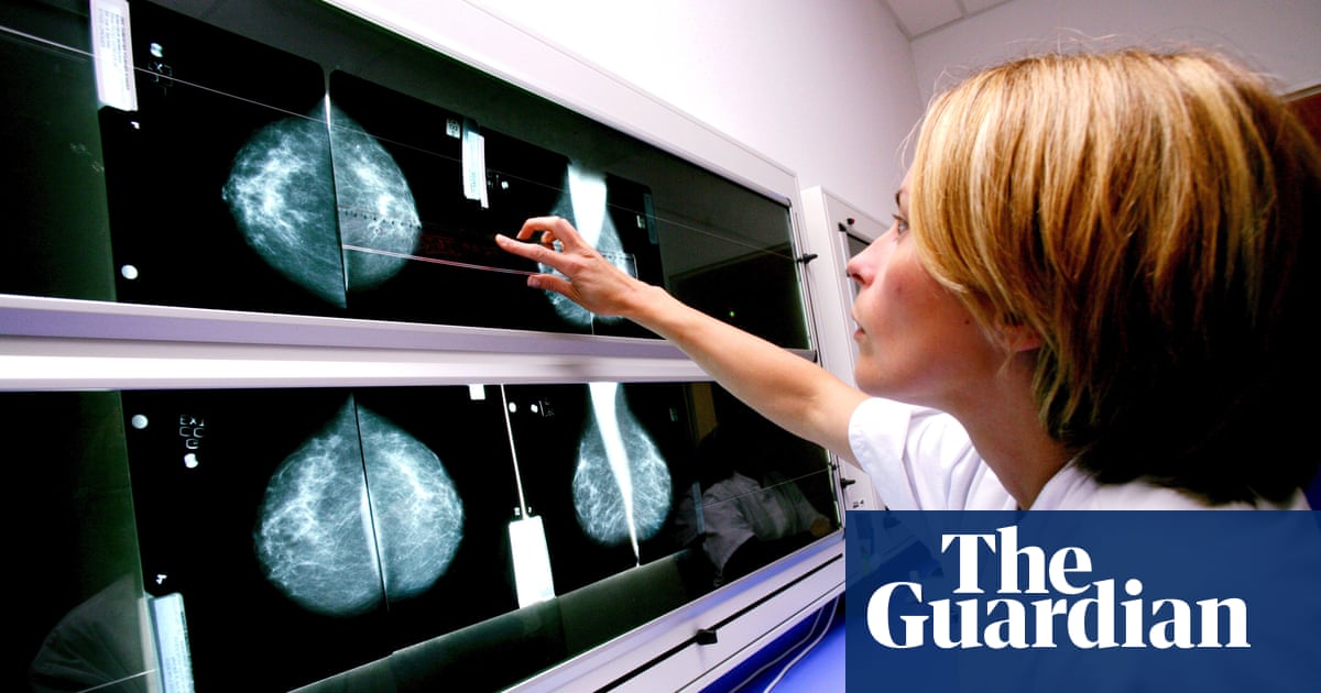 ‘Overdiagnosis’: some breast cancer treatments may have been unnecessary, study suggests