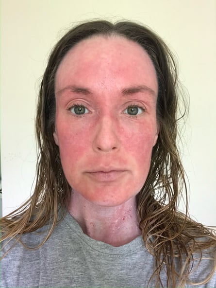 سلفي ابيگيل لو با پوستي قرمز و دردناك روي صورتش.