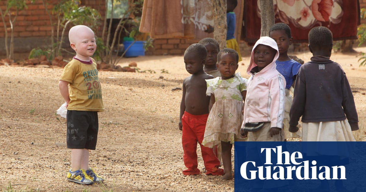 Look at her hair' – I wish albinism didn't make people stare | Students |  The Guardian