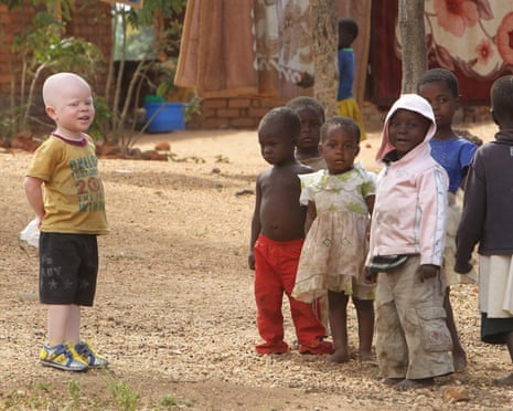 Cassim Jaffalie,3, stands with his friends at their family home in this Monday, May, 23, 2016 photo in Machinga about 200 kilometres north east of Blantyre Malawi.His father Razik Jaffalie gave up his work as a bicycle taxi operator to protect his son in a country where there has been an increase in albinism attacks. At least 18 Albino people have been killed in Malawi in a “steep upsurge in killings” since November 2014, and five others have been abducted and remain missing, a new Amnesty International report released Tuesday, June 7, 2016 says. (AP Photo/Tsvangirayi Mukwazhi)