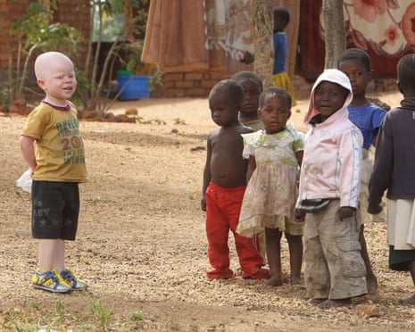 Cassim Jaffalie,3, stands with his friends at their family home in this Monday, May, 23, 2016 photo in Machinga about 200 kilometres north east of Blantyre Malawi.His father Razik Jaffalie gave up his work as a bicycle taxi operator to protect his son in a country where there has been an increase in albinism attacks. At least 18 Albino people have been killed in Malawi in a “steep upsurge in killings” since November 2014, and five others have been abducted and remain missing, a new Amnesty International report released Tuesday, June 7, 2016 says. (AP Photo/Tsvangirayi Mukwazhi)