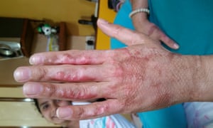 Her burned hand.