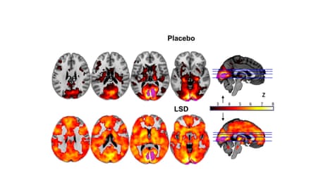 Brain scans on the brain on LSD and on a placebo