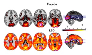 LSD brain scan