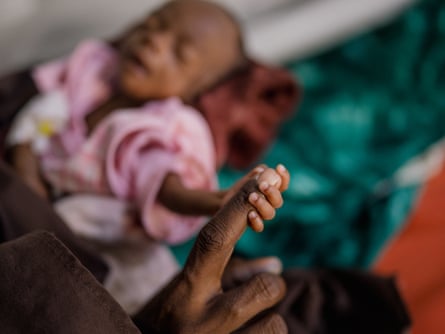 A malnourished babyâÂÂs tiny hand grips his motherâÂÂs finger in hospital