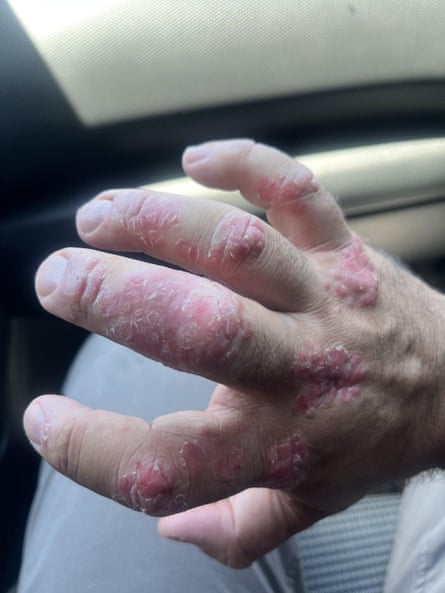 Santamaria’s hand without medication to treat his psoriasis, a skin disease that causes a rash with itchy scaly patches.