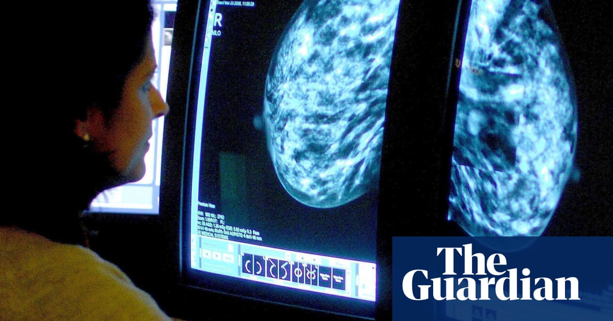 Extra cancer scans for women with dense breasts could save 700 lives a year UK study