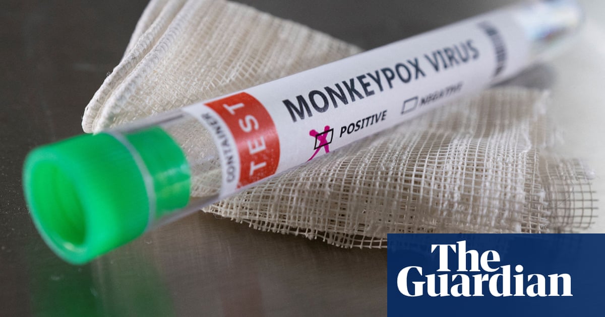 First case of monkeypox confirmed in Ireland