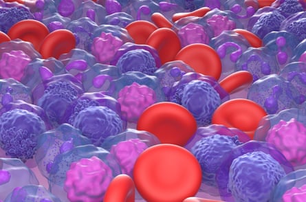 A 3D illustration of acute myeloid leukemia (AML) cells