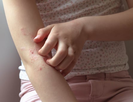 Infants with eczema are more likely to develop a food allergy.