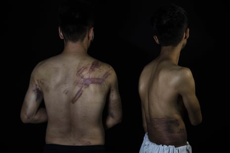 Two journalists show wounds sustained at the hands of the Taliban in 2021.