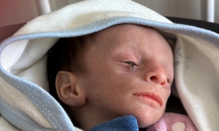 An infant with their eyes closed and a fly settled on their eyelid, wrapped in a blanket. The infant’s face shows they are very underweight