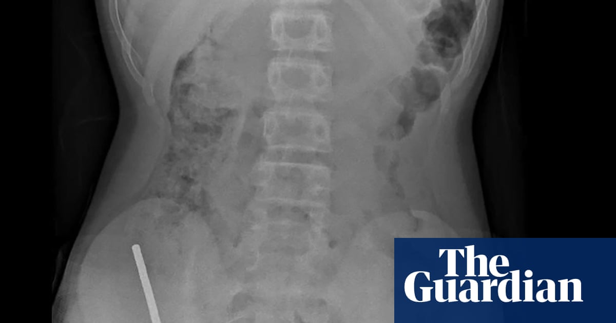 Surgeons remove high-power magnets from New Zealand teenager’s intestines