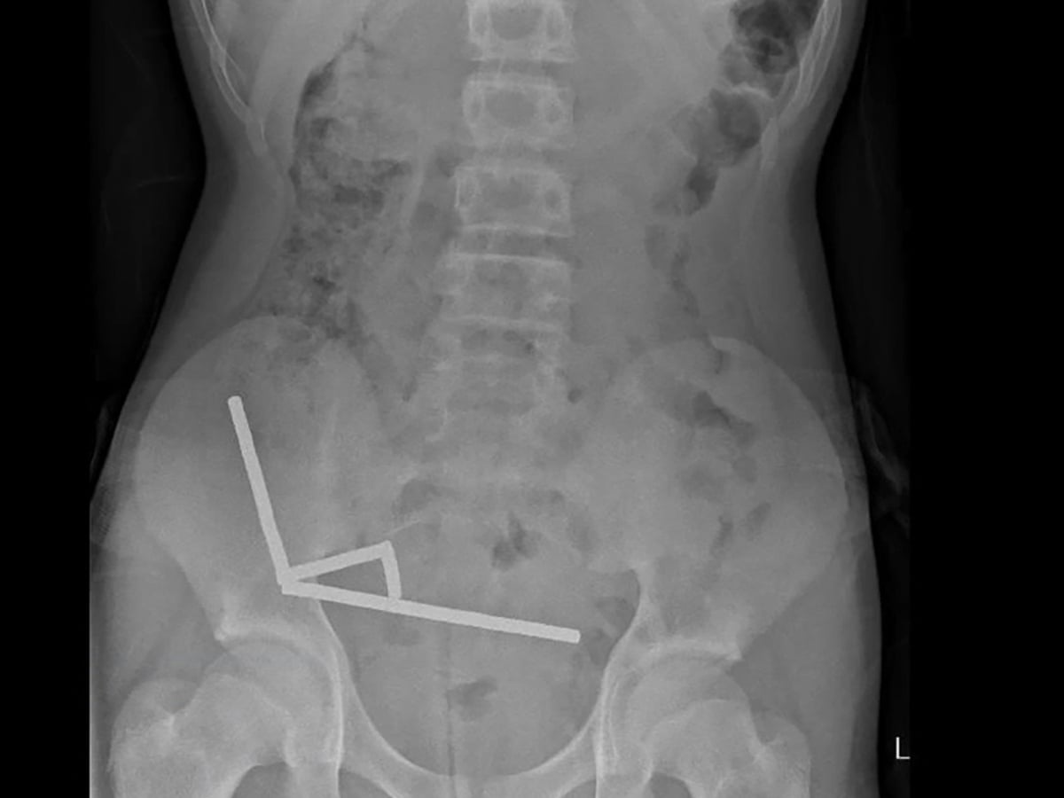 Surgeons remove up to 100 magnets from New Zealand teenager's intestines | New Zealand | The Guardian