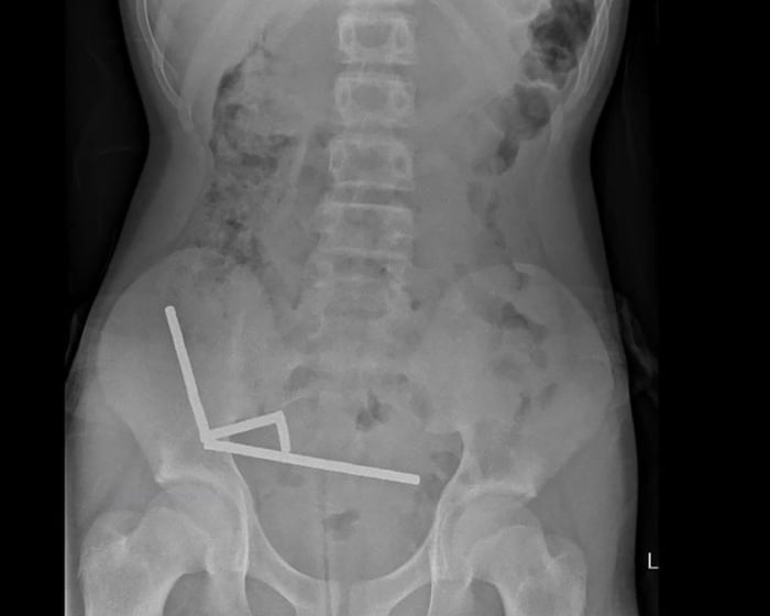 Surgeons remove up to 100 magnets from New Zealand teenager’s intestines