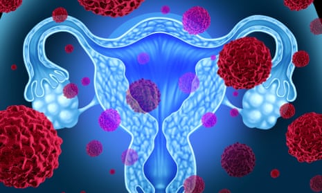 Illustration depicting cancer and uterus