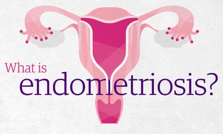 Ease Discomfort Caused by Endometriosis