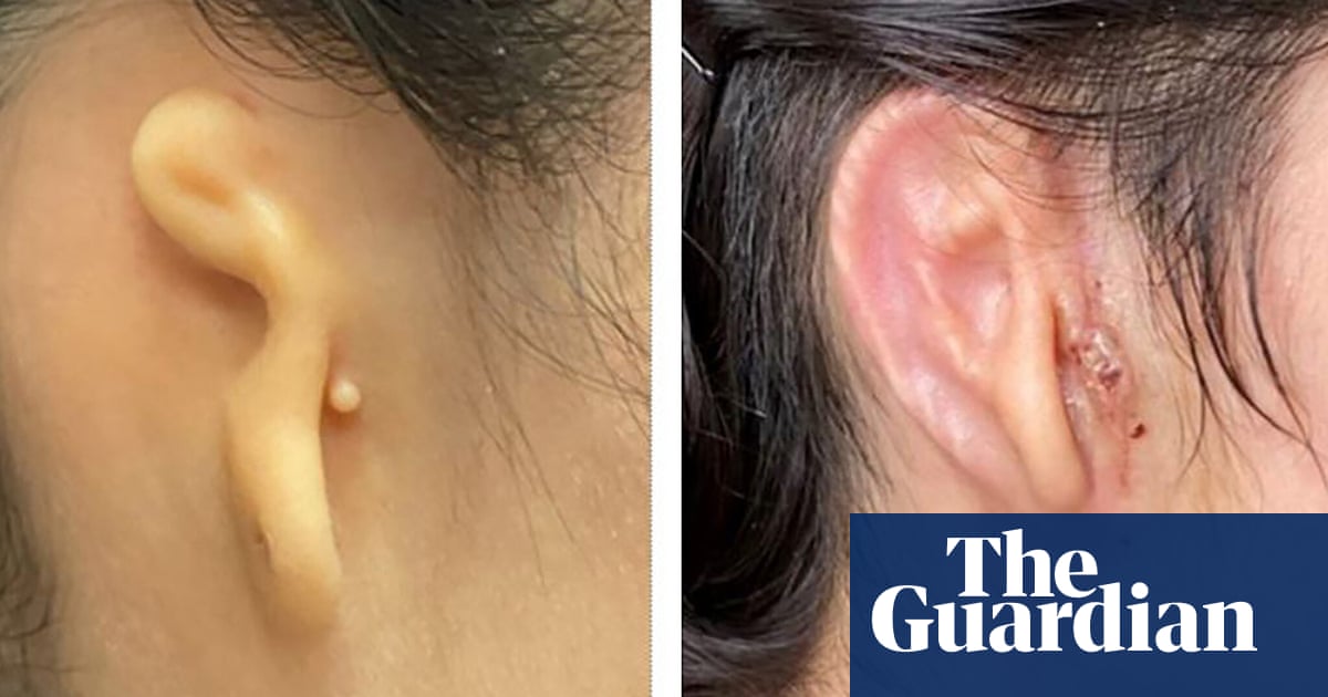 Woman’s ear rebuilt with 3D-printed living tissue implant