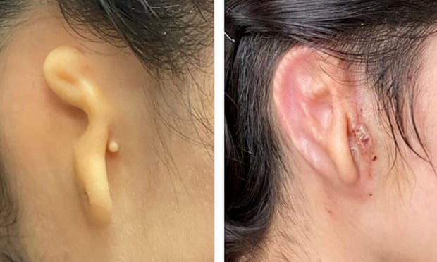The patient’s ear before and after the procedure