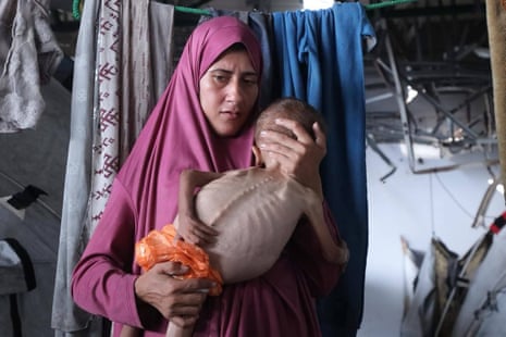Essa criança palestina, Mohammed al-Mutawaq, sofre de desnutrição, que exacerbou sua condição ao ponto de envenenamento, que levou à atrofia em seu corpo.