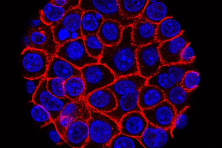 Pancreatic cancer cells under a microscope