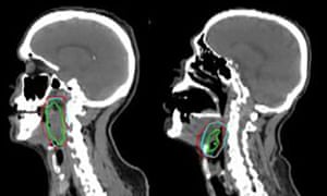 Software has been developed to accurately contour head and neck tumours