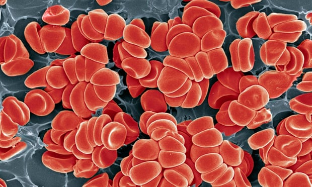 Blood clot. Coloured scanning electron micrograph (SEM) of red blood cells clumped together with fibrin to form a blood clot.<br>B6E2M5 Blood clot. Coloured scanning electron micrograph (SEM) of red blood cells clumped together with fibrin to form a blood clot.