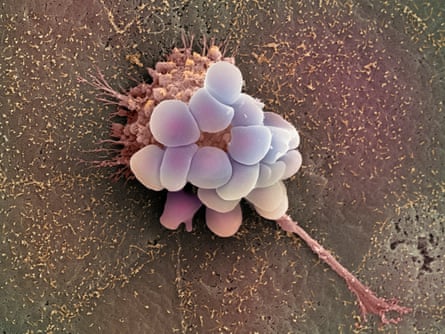 A coloured scanning electron micrograph of an ovarian cancer cell.