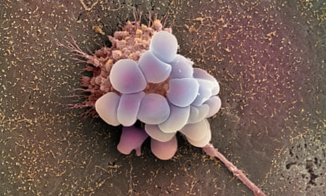 An electron micrograph image of an ovarian cancer cell. Ovarian cancer does not normally produce symptoms until it has reached an advanced stage yet the prognosis is poor unless it is detected early. 
