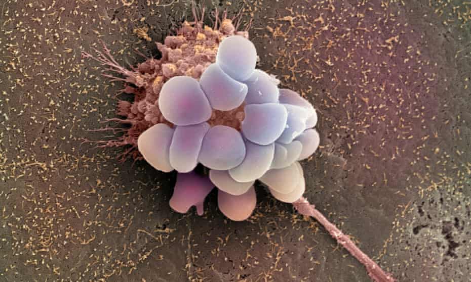 Coloured scanning electron micrograph (SEM) of an ovarian cancer cell. 