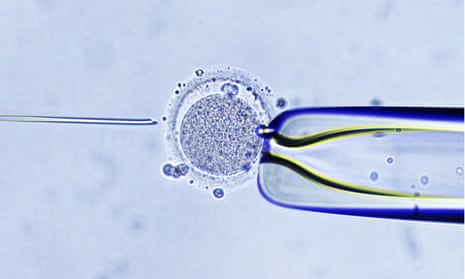 IVF - Injection of a sperm in the ovum