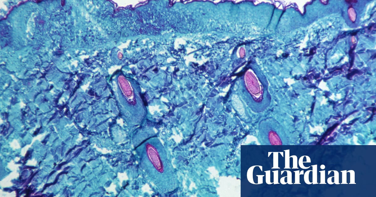 More monkeypox cases detected in UK ‘on daily basis’, says scientist