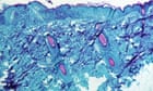 More monkeypox cases detected in UK 'on daily basis', says scientist