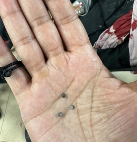 Cubes removed from a child by Sanjay Adusumilli, an Australian surgeon working at the al-Aqsa hospital in central Gaza.