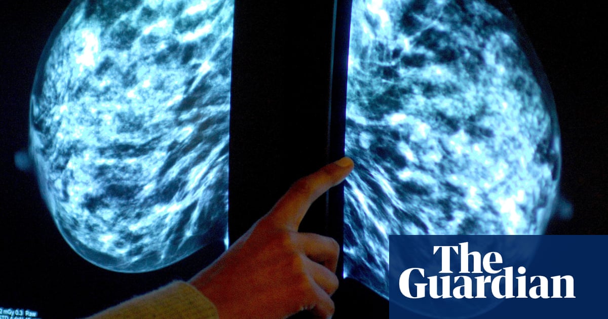 UK scientists working on breast cancer monitor fitted in bra